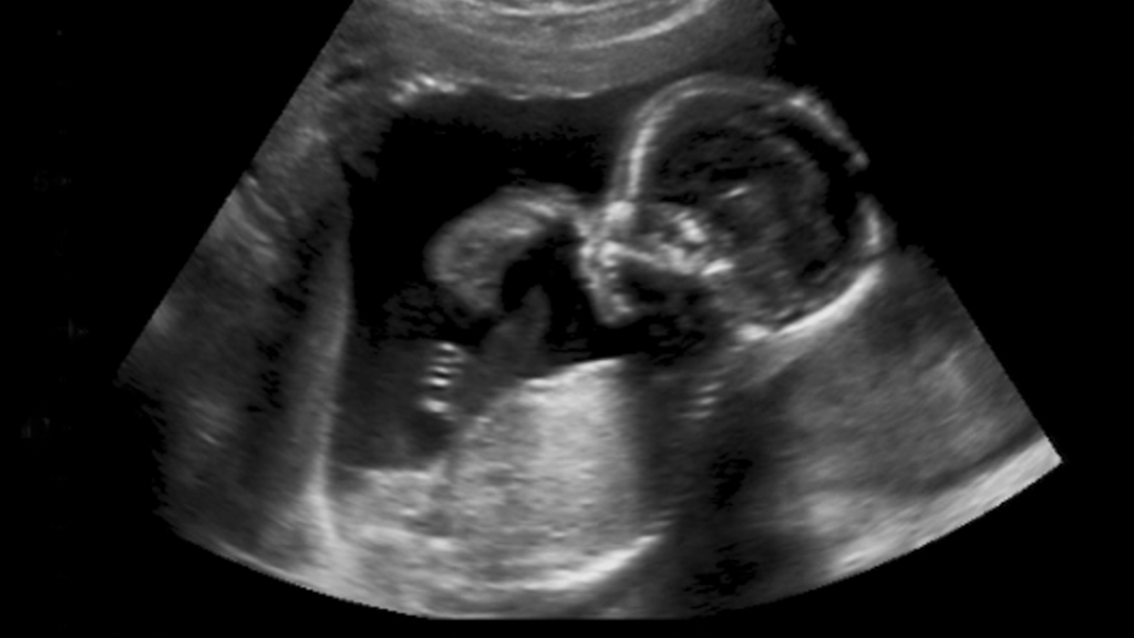 pregnancy ultrasound scan measurements used when calculating estimated due date
